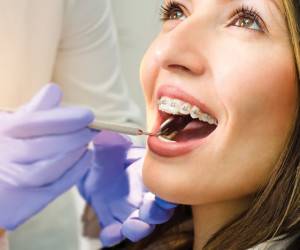 سوالات کلیدی قبل از درمان ارتودنسی دندان که باید بدانید