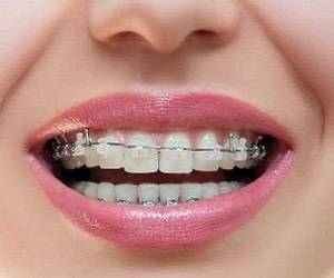 ارتودنسی باعث افزایش عمر دندان می شود