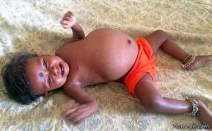 اعضای بدن جنین خواهر در شکم دختر ۱۵ ماهه + تصاویر