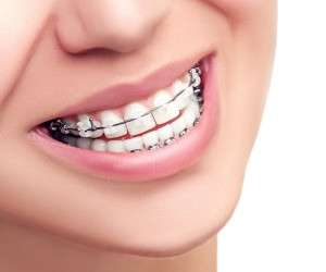 انواع مختلف ارتودنسی و ارتودنسی مناسب دندان شما
