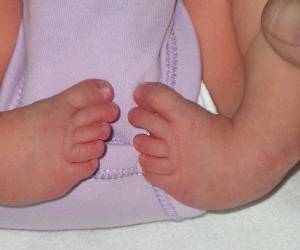 انواع پاچنبری نوزادان ؛ درمان کدام نوع سخت تر است؟