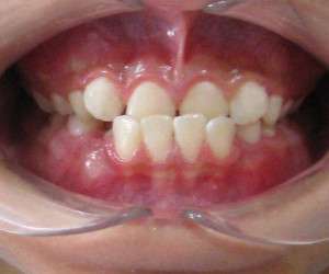 علت ناهنجاری کراس بایت دندان و روش درمان آن