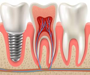 ایمپلنت یا کاشت دندان عالی کدام است؟ + تصاویر
