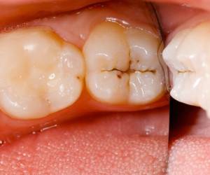 عامل اصلی پوسیدگی دندان ها این باکتریست