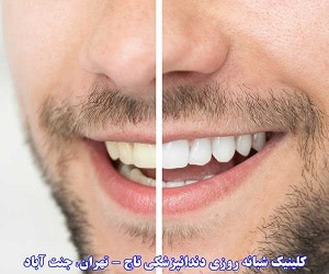 برای اصطلاح طرح لبخند لمینت بهتر است یا کامپوزیت؟