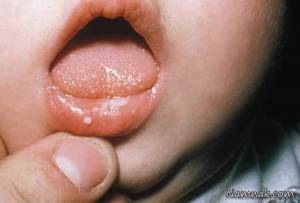 علل و علائم ایجاد برفک دهان در نوزادان