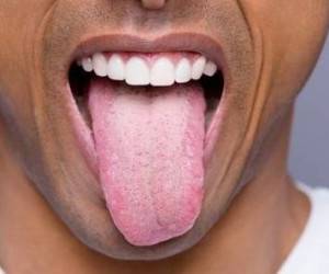 بیماری که زبان را دالبر می کند!