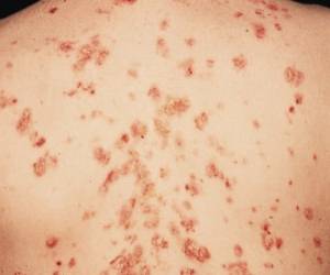 “بیماری پمفیگوس” ، سردسته بیماری های پوستی را میشناسید؟