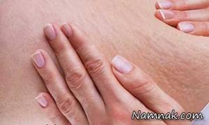 روشهای پیشگیری و درمان ترک های پوستی