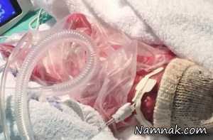 تولد نوزاد نارس ۹۰۰ گرمی + تصاویر