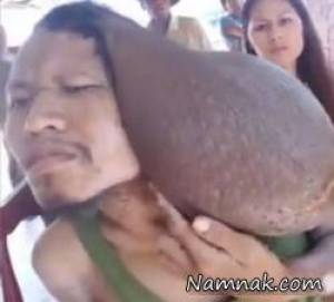 تومور وحشتناک ۳۵ ساله روی سر مرد تایلندی! + تصاویر