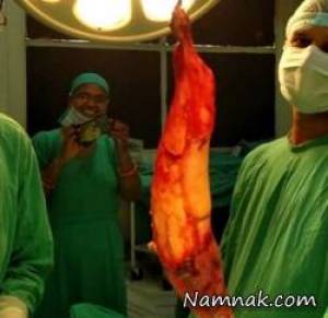 بزرگترین کیسه صفرای دنیا با جراحی خارج شد! + تصاویر