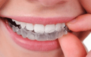 اثر مخرب جرم گیری بر مینای دندان