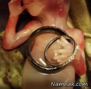 عکس جنین سقط شده ۱۹ هفته ای در دستان پزشک