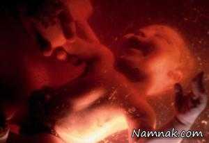 علامت جنجالی دست یک جنین در سونوگرافی! + عکس