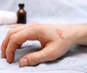 درمان سنتی جای سوختگی روی پوست