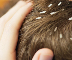 درمان آسان شپش موی سر با ۵ روش سرکه ای + آموزش