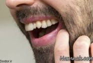 علت لق شدن دندان و درمان آن
