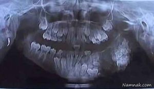 پسری با ۸۰ دندان اضافه جراحی شد + تصاویر