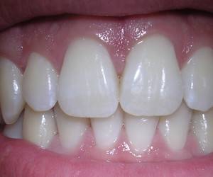 نسخه ابوعلی سینا برای داشتن دندانهای زیبا و لثه سالم