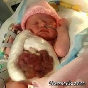 نوزادی که شکمش باز و روده هایش بیرون بود +تصاویر