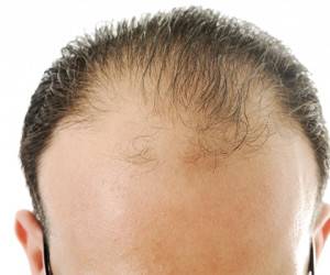 چگونه از “ریزش موی ارثی” جلوگیری کنیم + درمان ها
