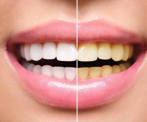 جرم گیری دندان چند بار در سال باید انجام شود؟