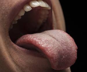 پیشنهاد طب سنتی برای درمان فوری سوختگی زبان