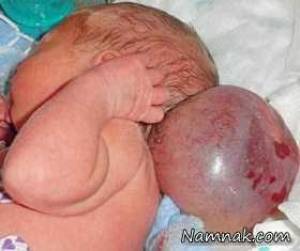 تولد نوزاد دو سر به دلیل ضایعه جمجمه + تصاویر