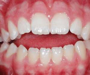از علت تا درمان اپن بایت یا جفت نبودن دندان ها