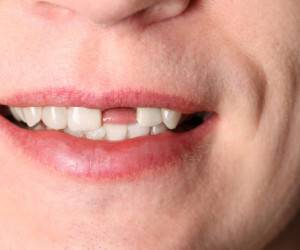 عوارض جای خالی حتی یک دندان در دهان
