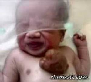 تولد نوزادی با کبد و قلب بیرون سینه + تصاویر