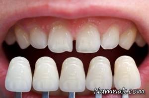 بیشترین علت جداشدن لامینیت از دندان