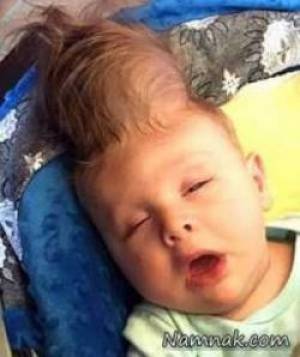 تولد نوزادی که مغزش بیرون جمجمه رشد کرده + تصاویر