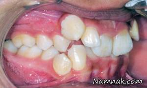 آشنایی با انواع ناهنجاری دندان