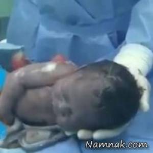 عجله نوزاد برای خارج شدن از شکم مادرش حین زایمان + عکس