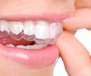 پروتز دندان چیست و انواع “پروتز دندان” کدامند؟