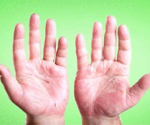 علت اصلی پوسته شدن انگشتان دست + درمان گیاهی