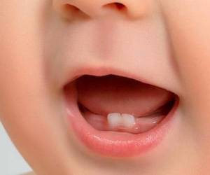 چطور مانع پوسیدگی دندان شیرخواران شویم؟
