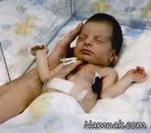 پیوند قلب بچه میمون به نوزاد ۱۲ روزه + تصاویر