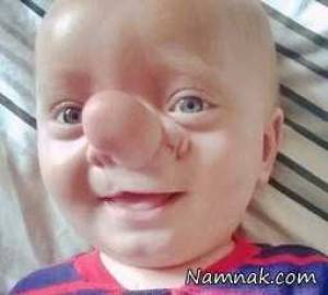 کودک عجیب که مغزش روی بینی رشد می کند+ تصاویر