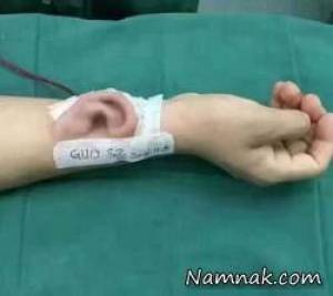 گوش مصنوعی که روی بازوی بیمار رشد کرد! + عکس