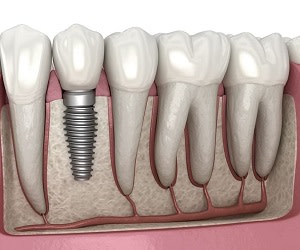 ایمپلنت دندان چیست و هزینه آن چقدر است؟