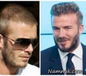 چهره هایی که کاشت مو انجام داده اند + عکس قبل و بعد