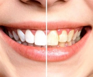 بارز ترین علت لکه ی قهوه ای بر روی دندان