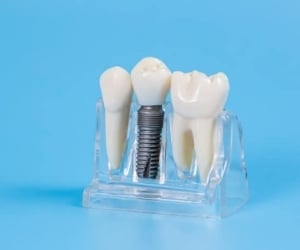 نکاتی برای کاشت دندان که باید بدانید