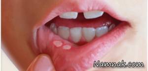 عوامل ودرمان موثر در ایجاد آفت دهانی